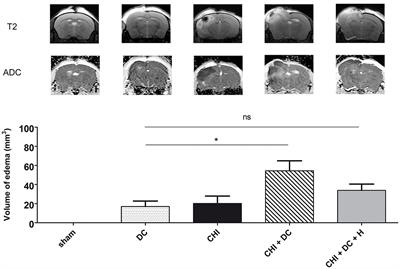 Changes in Posttraumatic Brain Edema in Craniectomy-Selective Brain Hypothermia Model Are Associated With Modulation of Aquaporin-4 Level